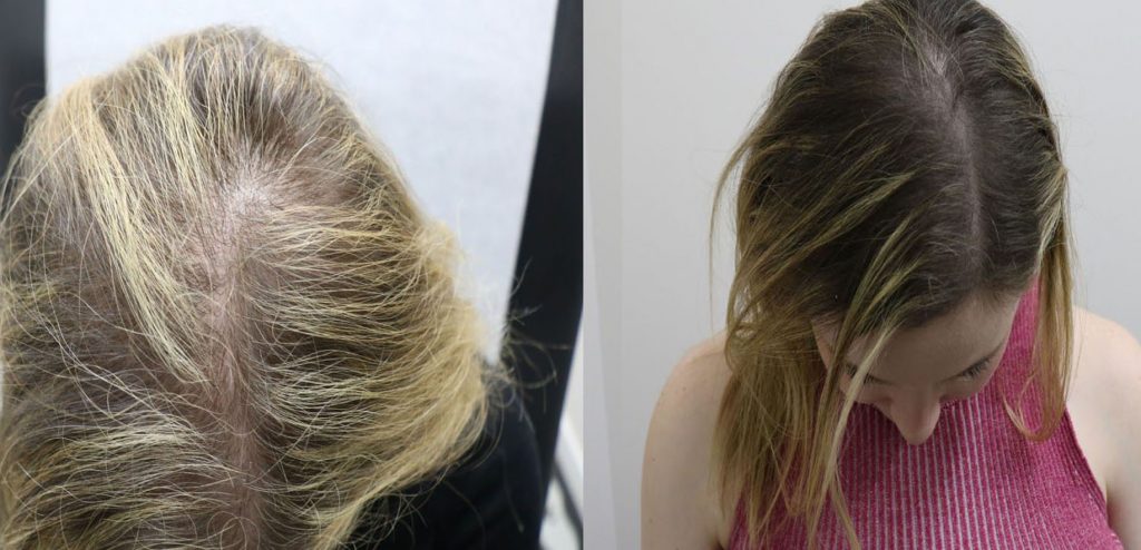 prp-hair-3 | Dermatologist Midtown - Pura Dermatology